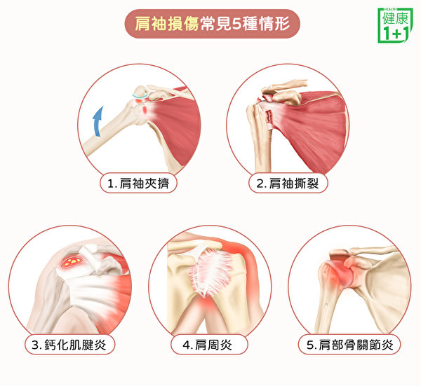 肩袖损伤常见五种疾病：肩袖夹挤（肩关节夹挤症候群）、肩袖撕裂、钙化肌腱炎肩周炎和肩部骨关节炎。（健康1+1／大纪元）