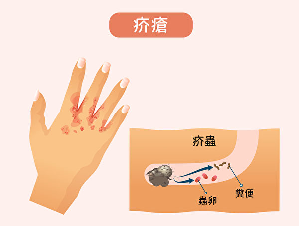疥瘡是由疥蟲侵入皮膚表皮的角質層所致。（Shutterstock/大紀元製圖）