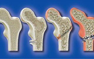 身體缺鈣導致骨質疏鬆的四大主因