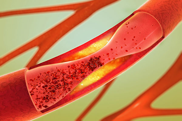 血液中壞膽固醇和中性脂肪高，是動脈硬化的警訊。(Shutterstock)