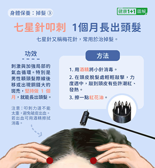防掉发第四招：用七星针（梅花针）叩刺，可以治疗掉发，特别是发际线后移和小的斑秃。（健康1+1／大纪元）