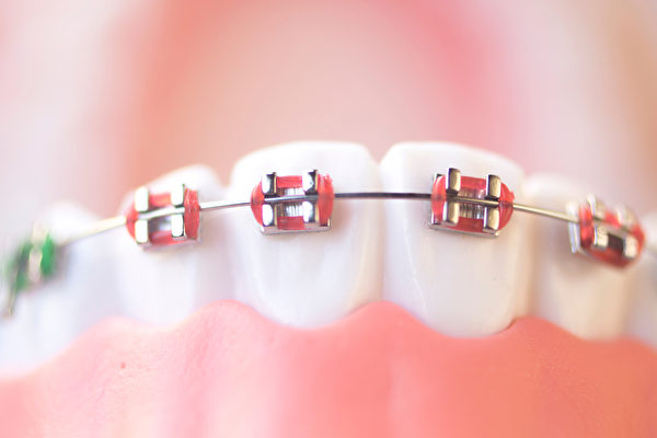 “钢线矫正器”算是历史悠久的传统牙齿矫正方法之一。(Shutterstock)