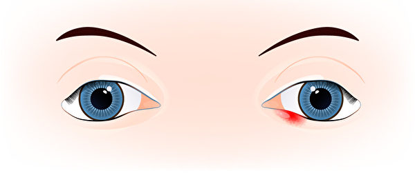 麦粒肿，俗称针眼，是眼皮或眼睑下的皮脂腺受到细菌感染，导致眼睫毛边缘出现红肿、长脓包的现象。(Shutterstock)