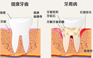 华人好发的口腔疾病──牙周病