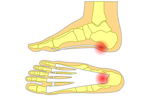 足底筋膜炎患者的脚跟骨与韧带衔接处长期承受压力及拉力，因而受伤，会引发骨刺。(Shutterstock)