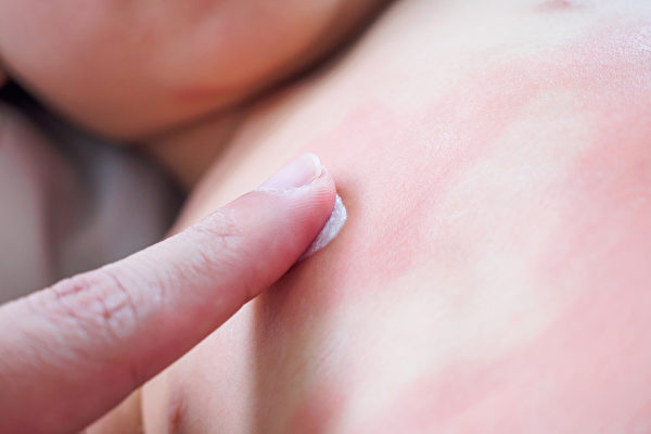蕁麻疹異常的癢，孩子如果不停搔癢，出現的紅疹塊會更多，所以必須先止癢。(Shutterstock)