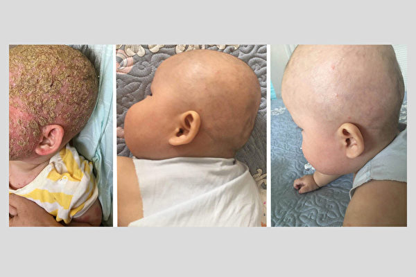 受益法輪功 折磨嬰兒的罕見皮膚病徹底痊癒