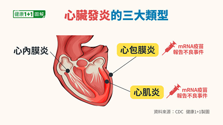 心臟發炎分為心肌炎、心包炎和心臟外膜炎，接種mRNA疫苗後出現的是前兩種。（健康1+1／大紀元）
