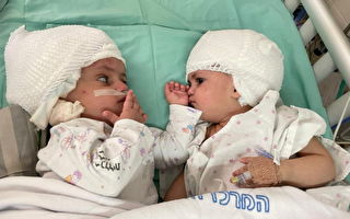 以色列首例 頭部相連雙胞胎12小時成功分離