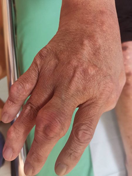 手指關節突然紅腫抽痛，到醫院檢查是痛風發作。