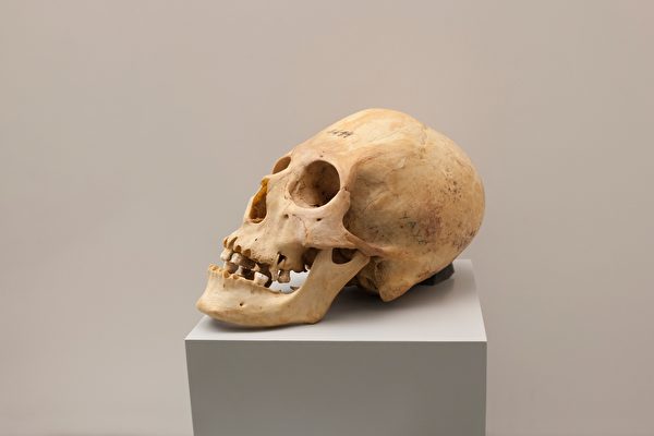 2000年前先进技术 秘鲁头骨嵌入不明金属