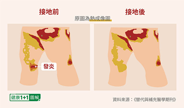 圖為女子接地前（左）及接地半小時後（右）的熱像圖之簡化示意圖，右膝嚴重發炎處明顯消炎。（健康1+1／大紀元）
