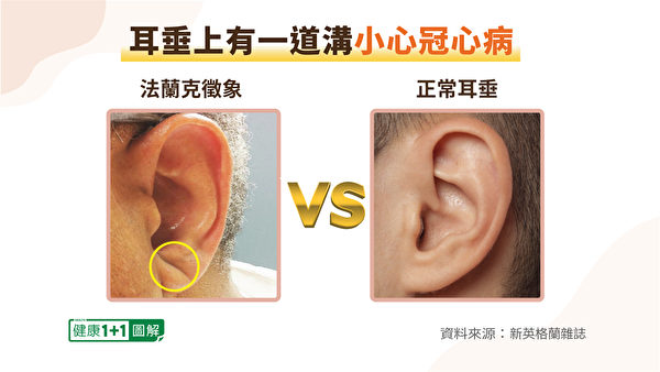 耳朵上的冠狀溝可以幫助早期預判冠心病。（健康1+1／大紀元）
