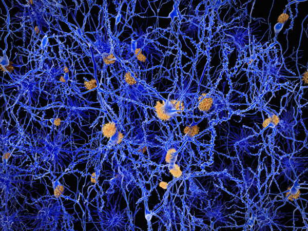 在阿兹海默症患者的大脑中，一种被称为“β-淀粉样蛋白”的东西成团堆积，就像棉线球一样。(Shutterstock)