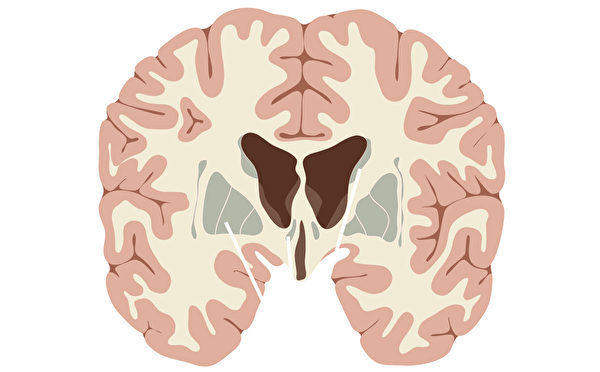 长期饮酒者和健康的人相比，大脑的灰质（外层）和白质（中间部分）都缩小。(Shutterstock)