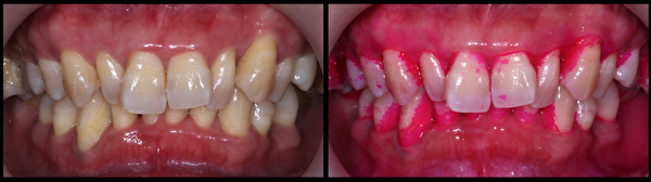 牙縫三角地帶、牙齒與牙齦相連的齒頸部的牙菌斑不容易刷乾淨。（徐志中醫師提供）