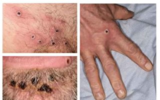 昆州新增10个猴痘病例 均为本地传染