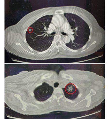 陳小姐檢查出右側(上圖)及左側(下圖)肺葉皆有腫瘤(紅圈處)，為肺腺癌第一期。