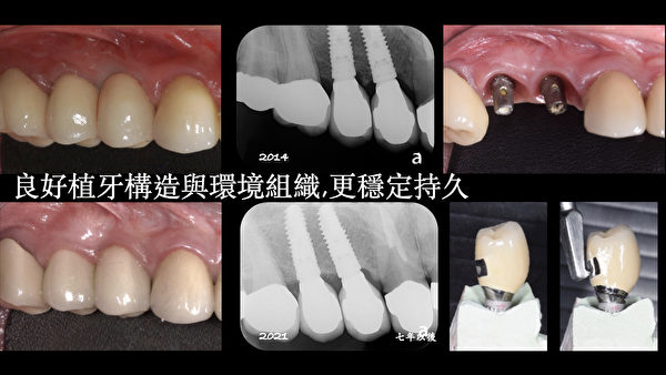植牙是將可以跟骨黏合的鈦金屬植體螺絲種到齒槽骨，取代「牙根」的功能。（李明科醫師提供）