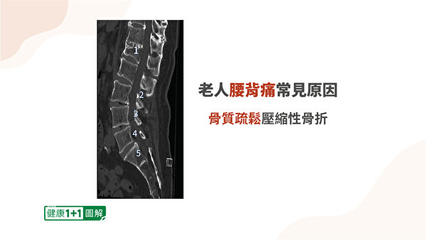 压缩性骨折使第一腰椎的椎体呈现楔形。（健康1+1／大纪元）