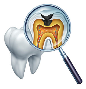 Tooth cavity close up and cavities symbol showing a magnifying glass with a cross section of a tooth anatomy in decay due to bacteria and acids in oral health care showing rotting and disease due to lack of brushing.