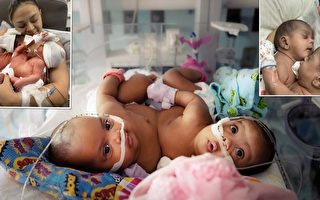 美国儿童医院成功分离16周大连体双胞胎