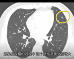 吉林知情人曝單位體檢內情 專家：肺癌性結節沒救