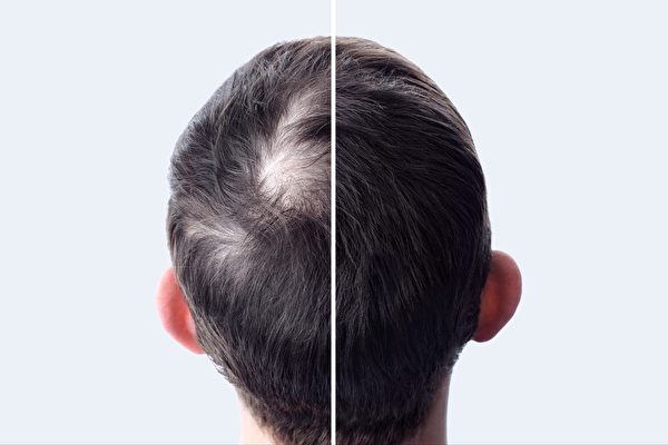 老化导致头发脱落、变白 7种营养素让头发回春