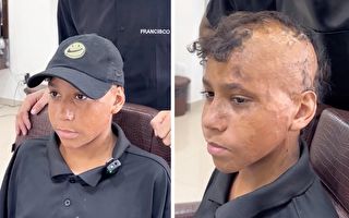 理髮師為燒傷男孩長出「新髮」 助他恢復自尊