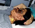 遭警電擊毀容 高蓉蓉生命危急