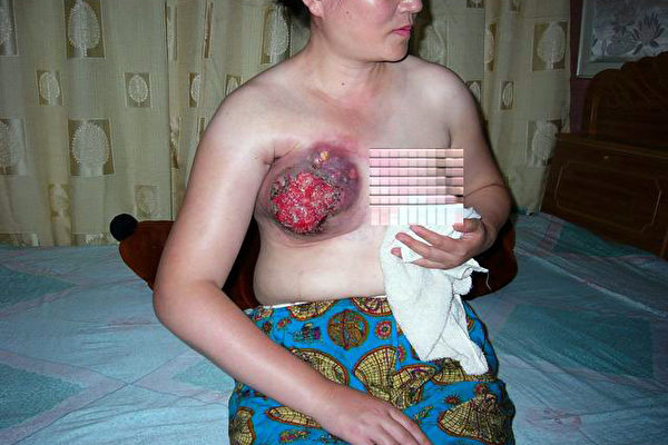 王云洁被马三家警察用几千伏的高压电棒电击乳房，导致整个乳房溃烂。(明慧网)