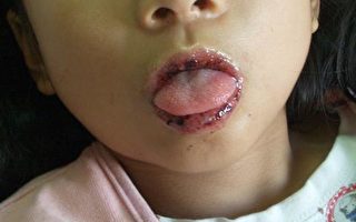 高燒超過5天病童  應小心是否為川崎病