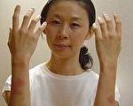 希望之聲國際廣播電台台灣記者廖淑慧手部被抓傷（圖片提供：希望之聲國際廣播電台）