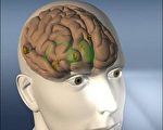 世界首例电极植入脑 病患恢复意识