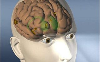 世界首例电极植入脑 病患恢复意识