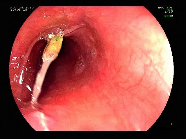 鱼刺卡喉咙 喝醋 吃馒头吞饭有用吗 答案全在这 知乎