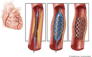 滥用心支架调查报告 恐致病患延误治疗