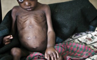 联合国：非洲之角儿童极度营养不良