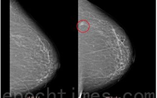 X光乳房攝影 早期發現乳癌利器