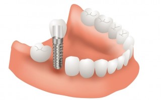 缺牙最佳的修復方法  植牙
