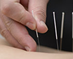 中國的針灸被西方人稱為「東方魔針」，被譽為世界醫學史上的奇蹟。（攝影：Max Tactic/Fotolia）
