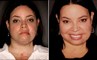 美國慈善外科醫生組織Face to Face為家暴受害者莫拉萊斯進行整容，消除了她面部和頸部的疤痕。（Face to Face提供）