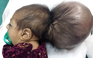 阿富汗双头女婴 成功切除一多余头颅
