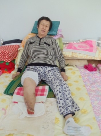 宋慧兰的右脚掉了。(明慧网) 宋慧兰的右脚掉了。(明慧网)