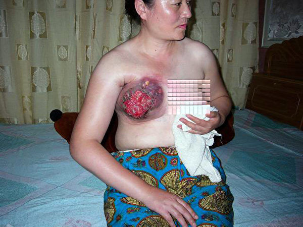 王云洁被电棒电击致使乳房溃烂(明慧网) 王云洁被电棒电击致使乳房溃烂(明慧网)