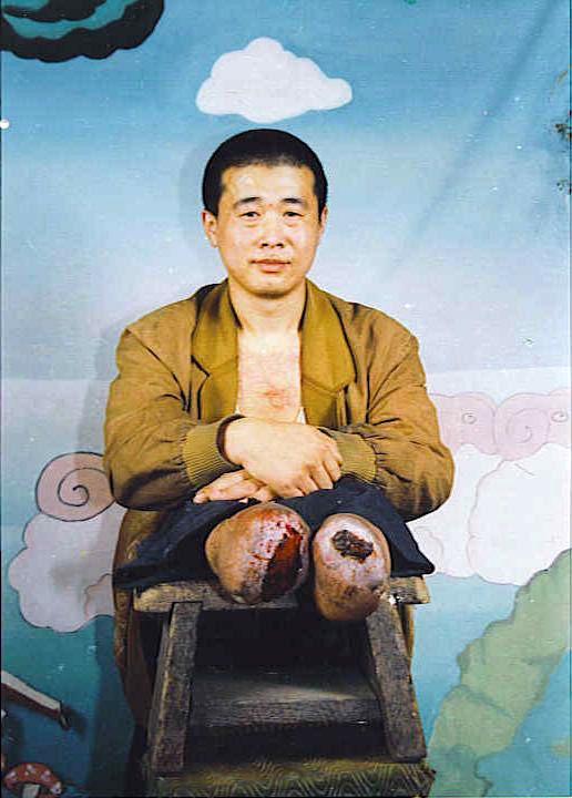 法轮功学员王新春被迫害致残,双脚脱落。(明慧网) 法轮功学员王新春被迫害致残,双脚脱落。(明慧网)