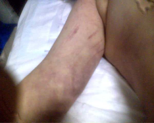 身体上被殴打的伤痕(明慧网) 身体上被殴打的伤痕(明慧网)