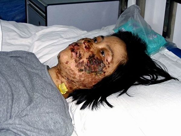 高蓉蓉遭中共警察残害,严重毁容(明慧网) 高蓉蓉遭中共警察残害,严重毁容(明慧网)