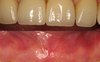 针孔牙龈增生术