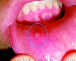 口腔生痱滋往往令人苦不堪言，使用天然成分的消毒喷剂，可迅速解除痛苦，又无副作用。（Wikipedia）